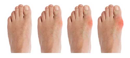 foods that contain high amounts of uric acid gout relief hot or cold home treatment for gout in foot